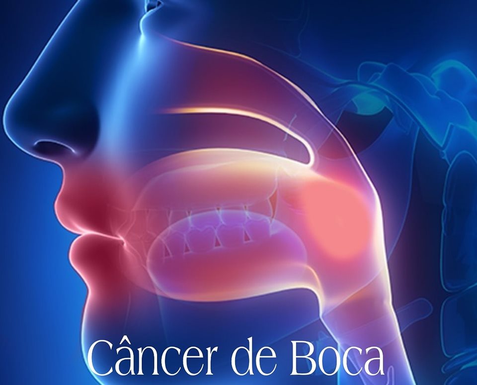 Câncer de boca